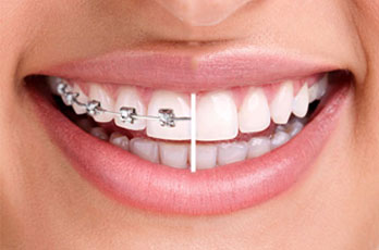 braces before and after braces before and after