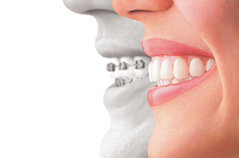 Invisalign before and after Invisalign before and after